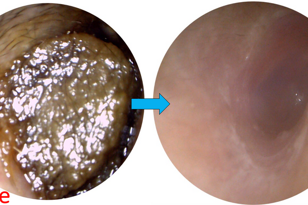 Earwax Removal 101